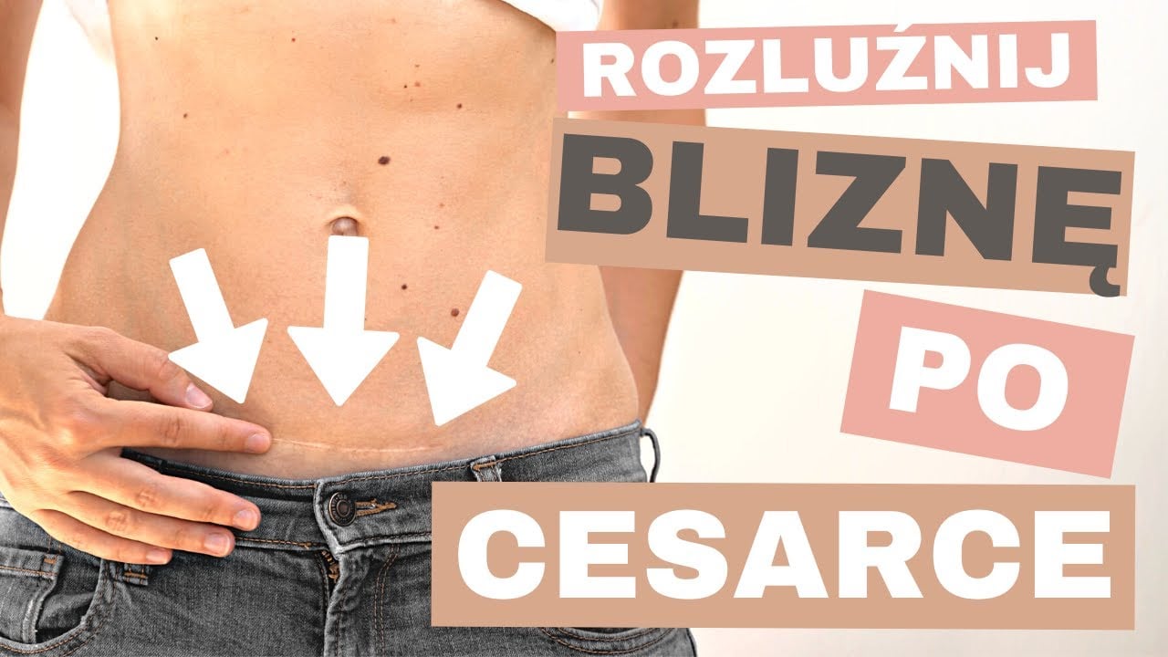 Jak rozluźnić BLIZNĘ po cesarskim cięciu - WSZYSTKO co musisz wiedzieć!