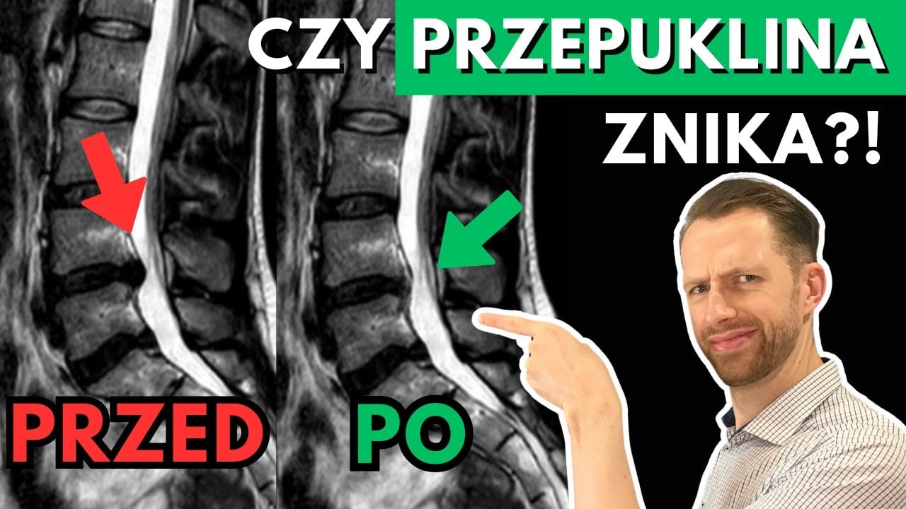 PRZEPUKLINA może ZNIKNĄĆ! - ćwiczenia, dyskopatia, rwa kulszowa, lumbago, wypuklina