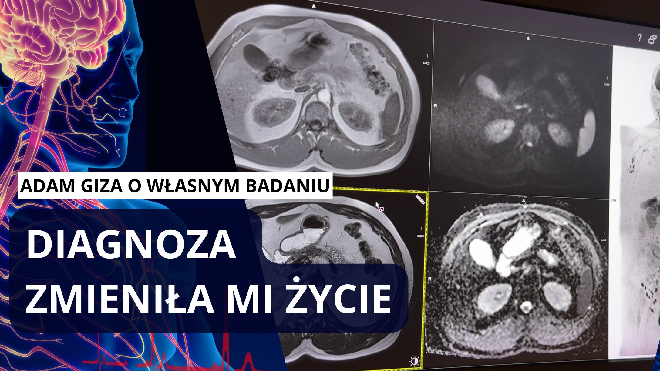 Diagnoza zmieniła moje życie! |GIZA u siebie szukał nowotworów - opowie o wynikach rezonansu