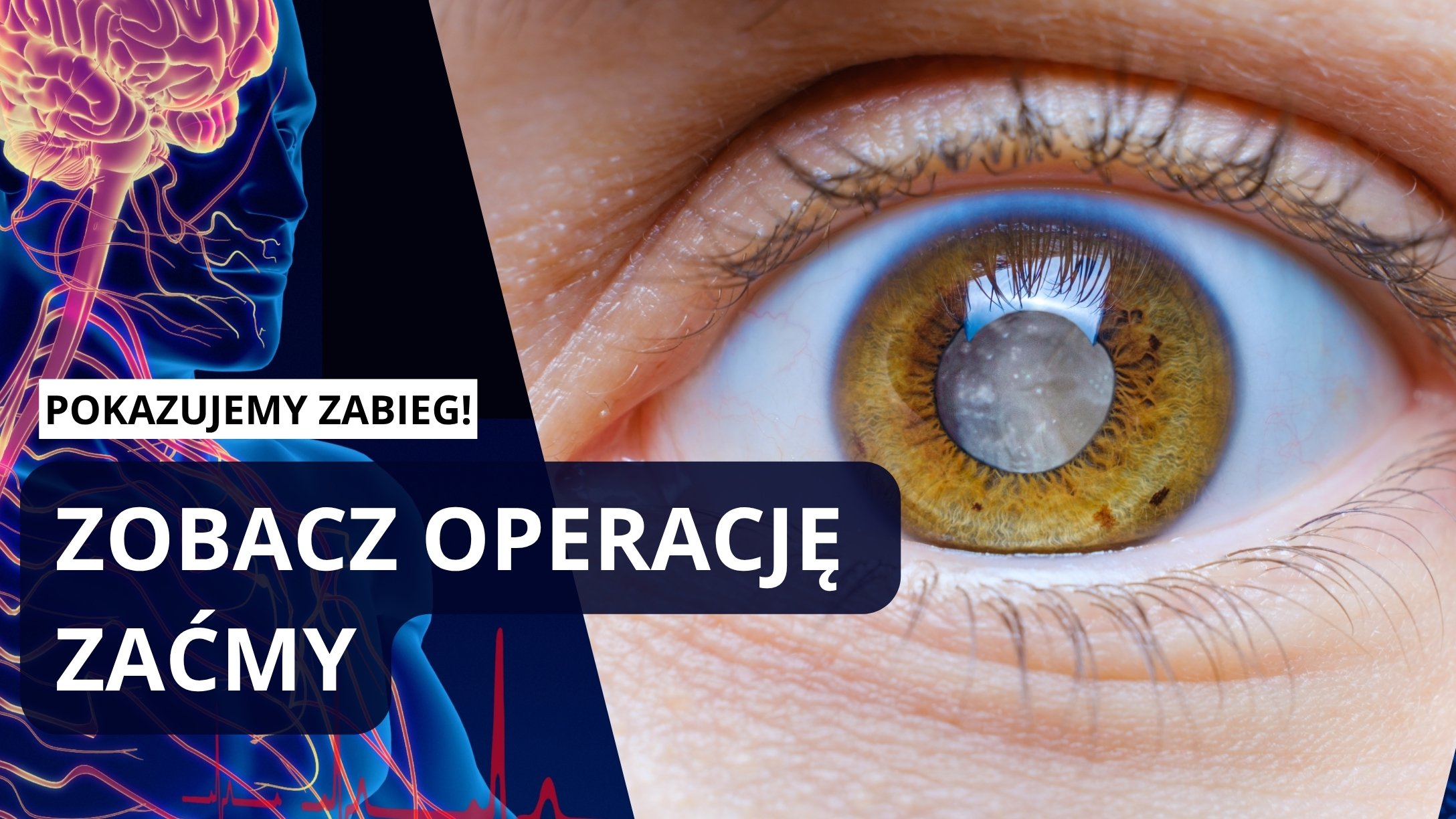 Tak wygląda operacja zaćmy | prof. Jacek Szaflik operuje i opowiada  | Dowiedz się czym jest zaćma!