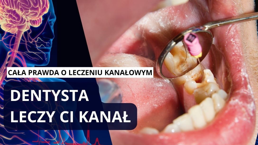 Leczenie kanałowe zębów. Kiedy taki zabieg jest konieczny. Odpowiada dr Michał Portas