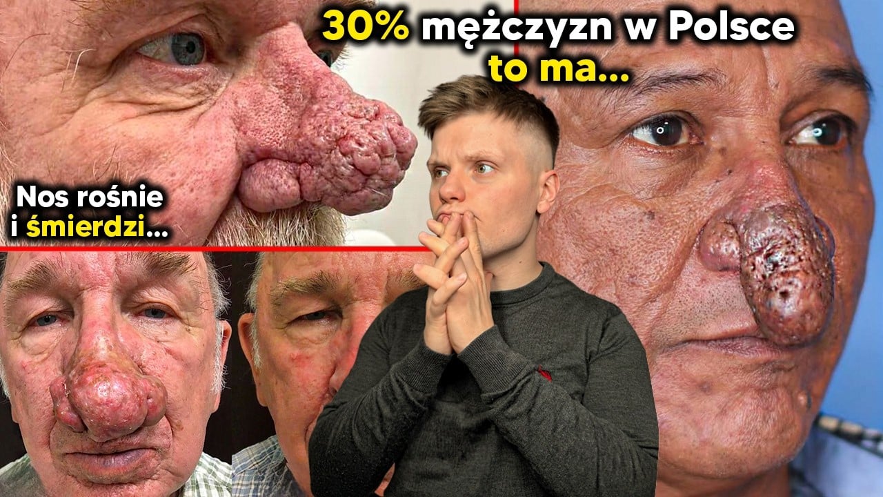 Gdy twój nos staje się BULWĄ... GUZOWATOŚĆ nosa, okropna przypadłość