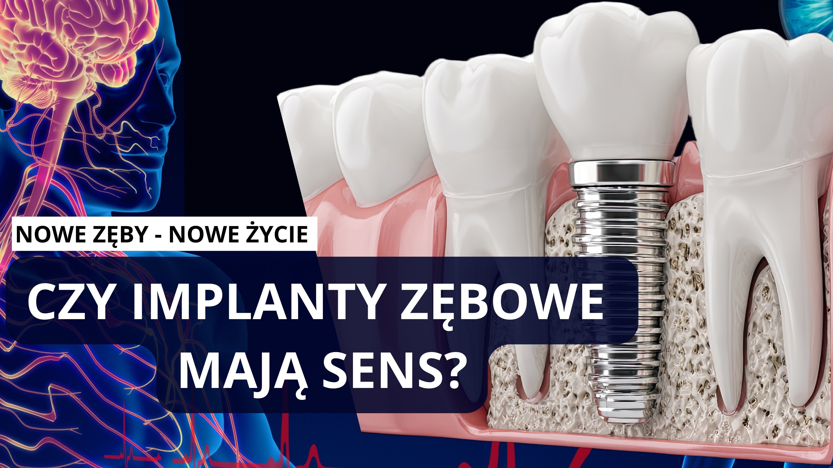 Implanty zębowe ile to kosztuje? Czy to boli? Na ile wytrzyma?