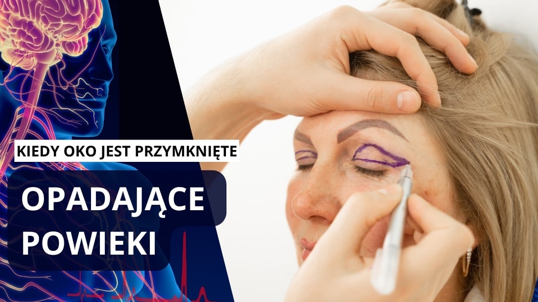 Opadające powieki — kiedy warto rozważyć operację? | wywiad z dr Marcinem Jadczakiem